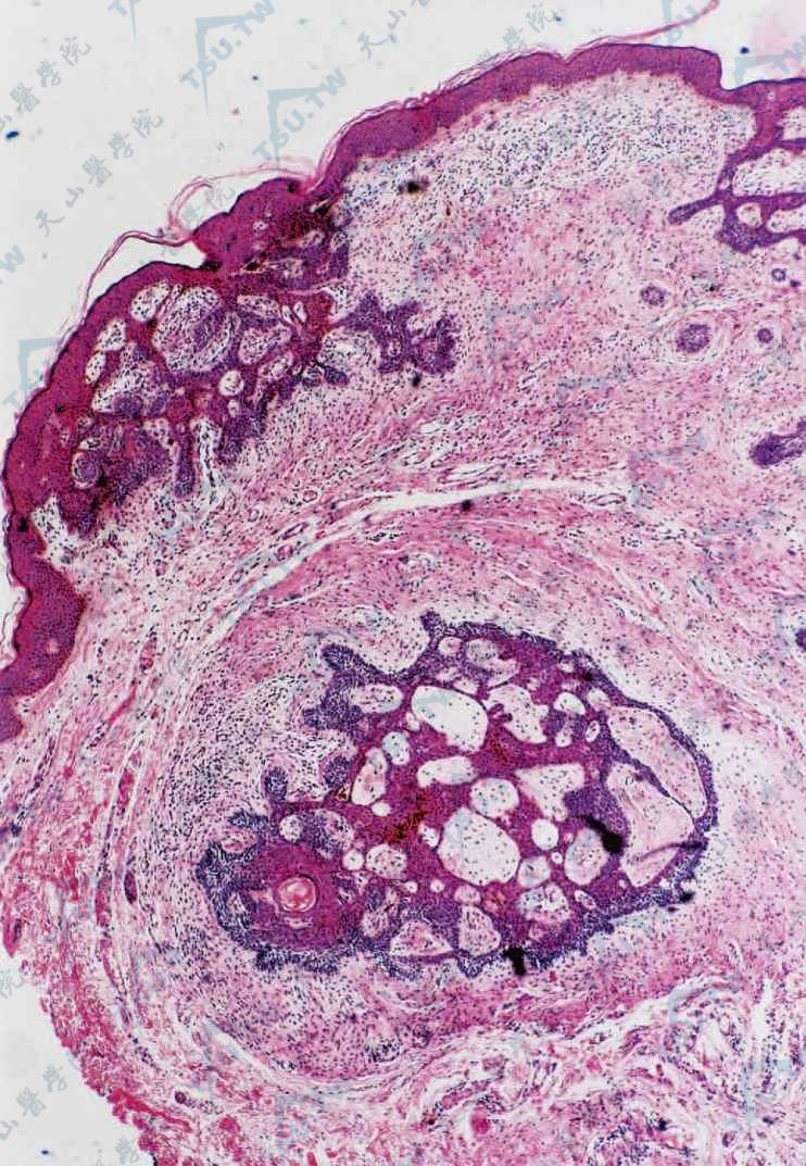 纤维毛囊瘤（Fibrofolliculoma）真皮内毛囊周围有纤维组织包绕，基底样细胞条索互相吻合成网状团块，部分与表皮相连