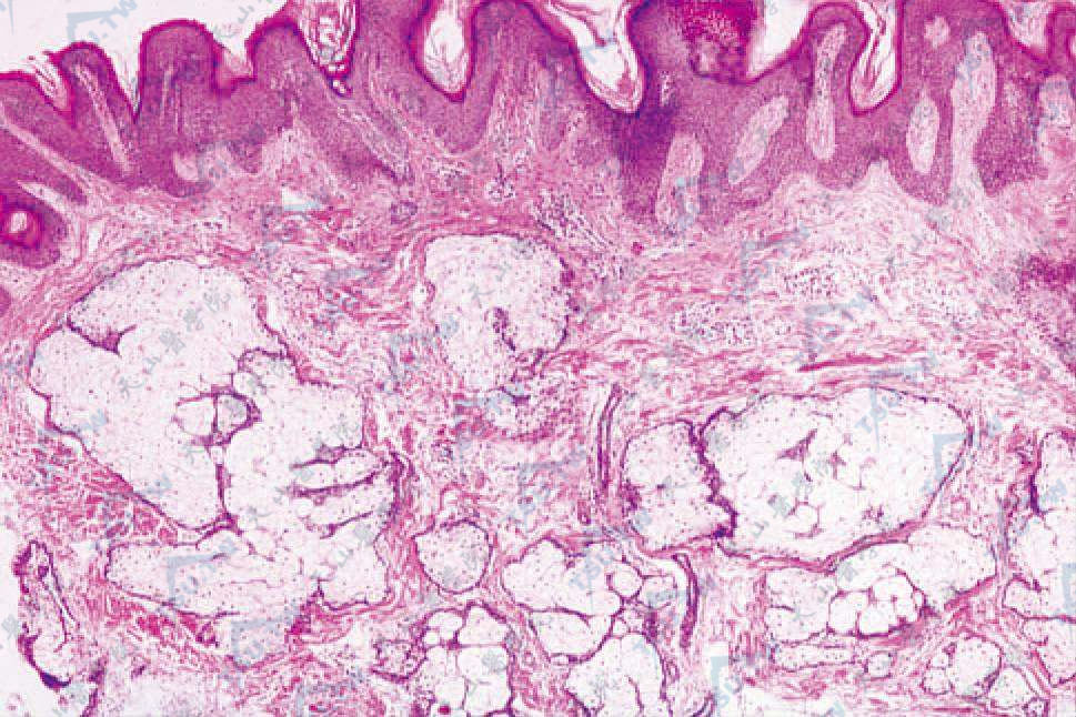 线状皮脂腺痣综合征　表皮呈乳头瘤样增生，角化过度，皮脂腺过度增生呈结节状
