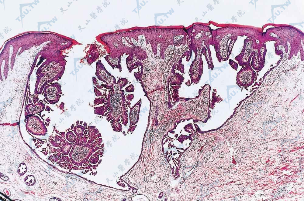 乳头状汗管囊腺瘤组织病理学改变：表皮向下内折为囊腔，内有多数绒毛样突起，绒毛由两层上皮细胞组成