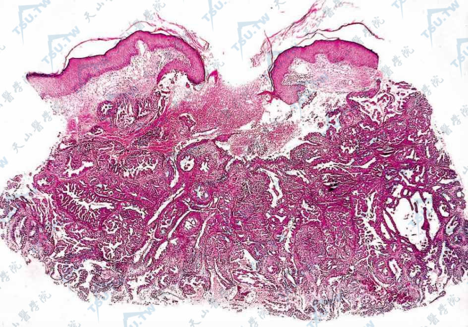 乳头糜烂性腺瘤病组织病理学：瘤体由基底样细胞组成，细胞核圆，呈嗜碱性，胞质少，细胞形状大小不一，无异型性（×40）