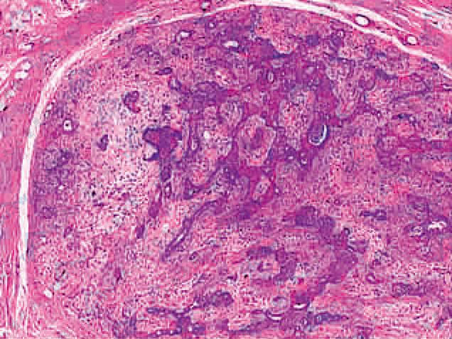 皮肤混合瘤（Mixed Tumor of the Skin）组织病理学改变