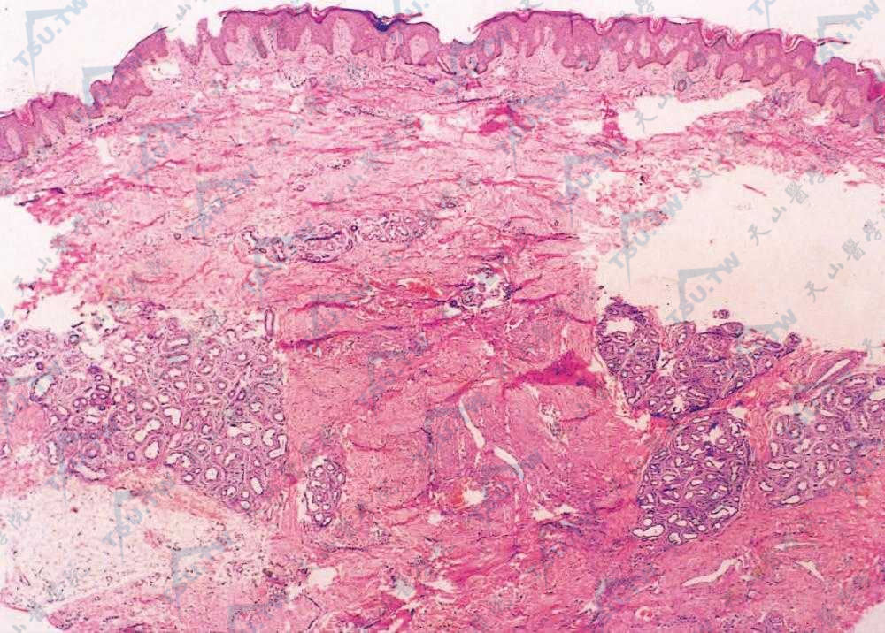　正常成熟小汗腺增多增大，未见血管瘤样改变（HE染色×100）