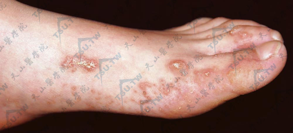 左足内侧缘、足背和足趾伸侧散在分布许多角化性丘疹