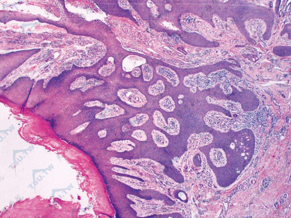 小汗腺汗孔瘤　表皮角化过度，棘层肥厚，皮突延长，肿瘤细胞向真皮内延伸