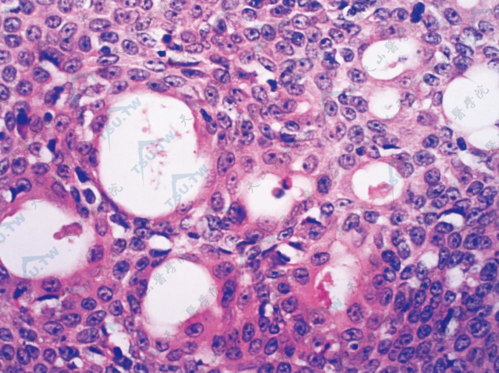 肿瘤细胞条索或团块中可见许多狭窄的管腔和囊腔
