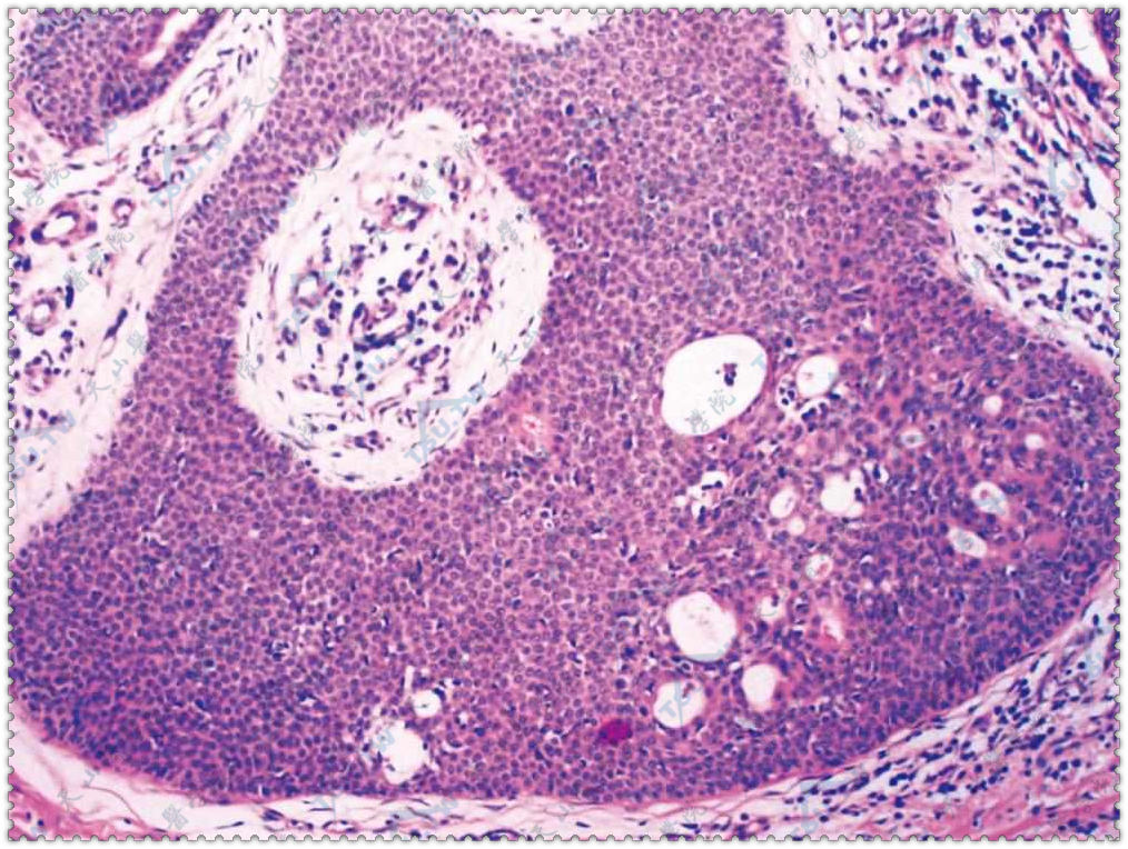 肿瘤细胞较棘细胞小，立方形，核圆，深嗜碱性，大小一致，未见核丝分裂象