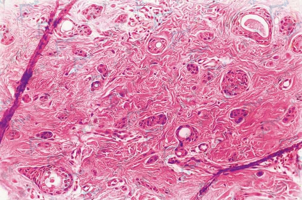汗管瘤（Syringoma）组织病理学：真皮内多个囊性管腔和实性细胞索，个别囊腔壁连着实性细胞索呈“蝌蚪状”