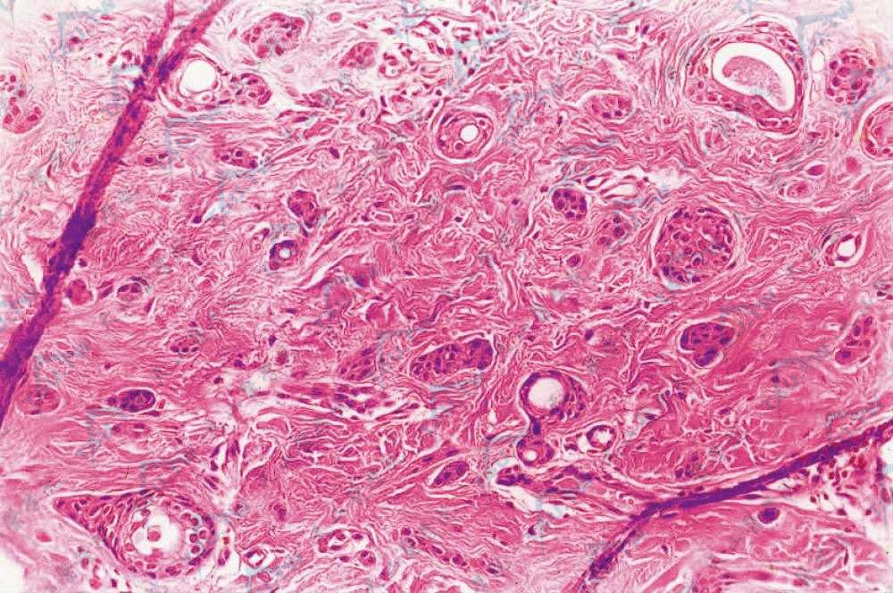 汗管瘤（Syringoma）组织病理学：真皮内多个囊性管腔和实性细胞索，个别囊腔壁连着实性细胞索呈“蝌蚪状”