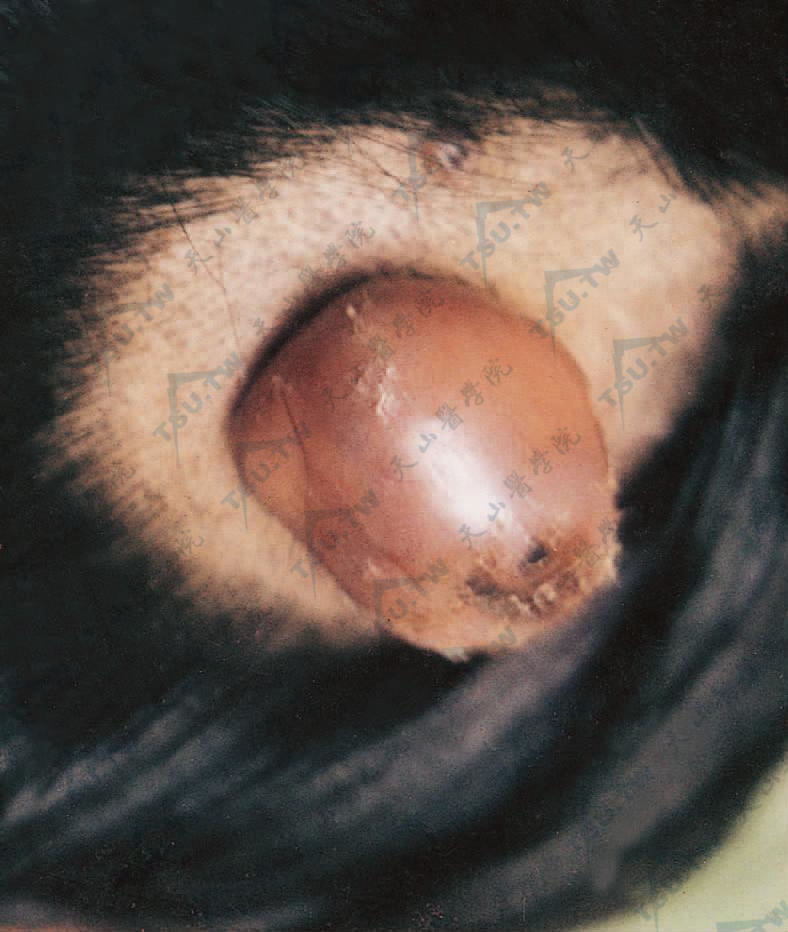 头部透明细胞汗腺瘤患者症状：头部一圆形肿块，肉红色，表面光滑完整，有糜烂、破溃，中等硬度