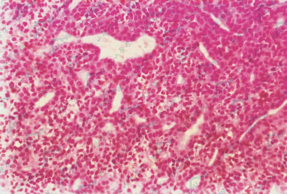 小汗腺螺旋腺瘤瘤细胞排列成条索状，围成小管腔相互连接（HE染色×200）