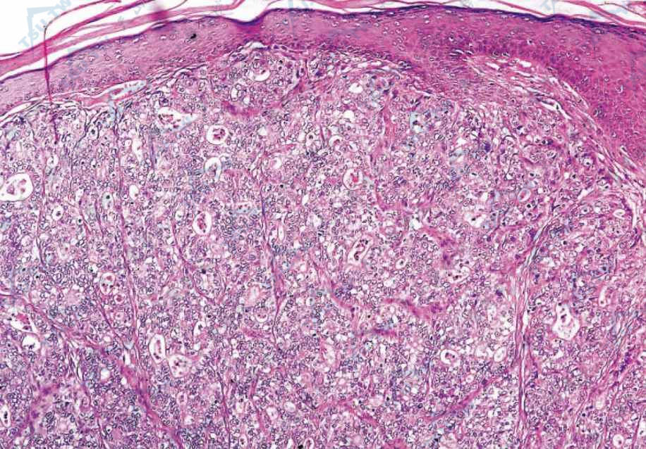 真皮内肿瘤细胞巢可见管腔样结构，肿瘤细胞由2种类型的细胞构成