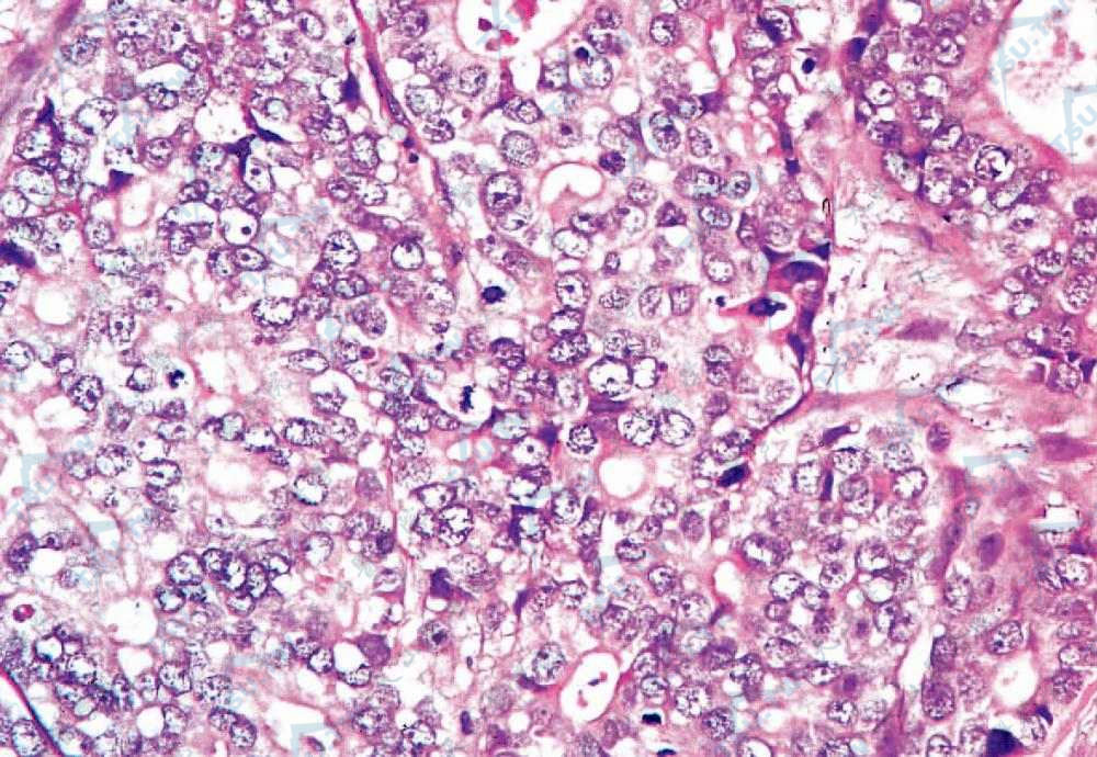透明细胞汗腺癌　2种类型的细胞核分裂和核异形均明显（HE染色×400）