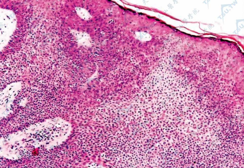 小汗腺汗孔癌　肿瘤位于表皮内，由基底样细胞和少数呈团块状分布的不典型嗜伊红鳞状细胞组成