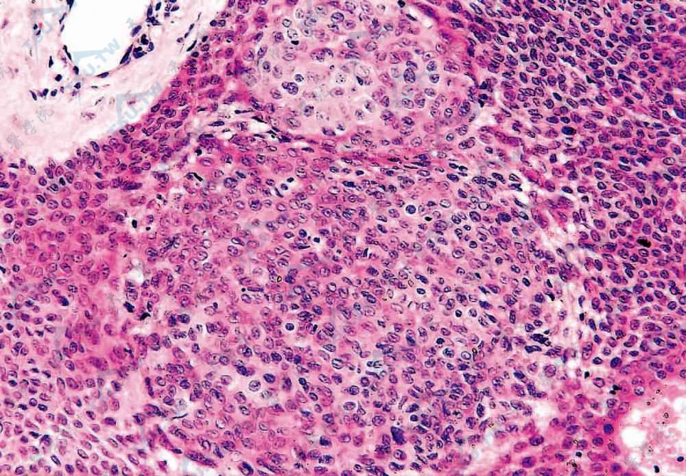 小汗腺汗孔癌　周围基底样细胞体积较小，呈立方形，排列紧密，中央不典型嗜伊红鳞状细胞体积较大，核深染，有明显异型性