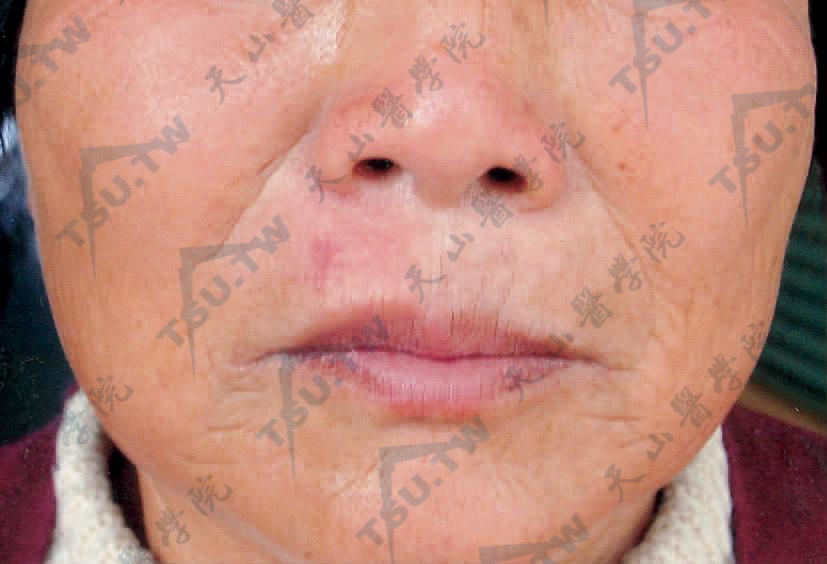 微囊肿附属器癌症状：右鼻唇沟内侧一淡红色结节，边界相对清楚