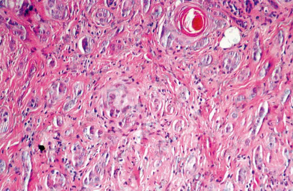 微囊肿附属器癌（恶性汗管瘤）部分细胞不典型有少数核丝分裂象（HE染色×200）