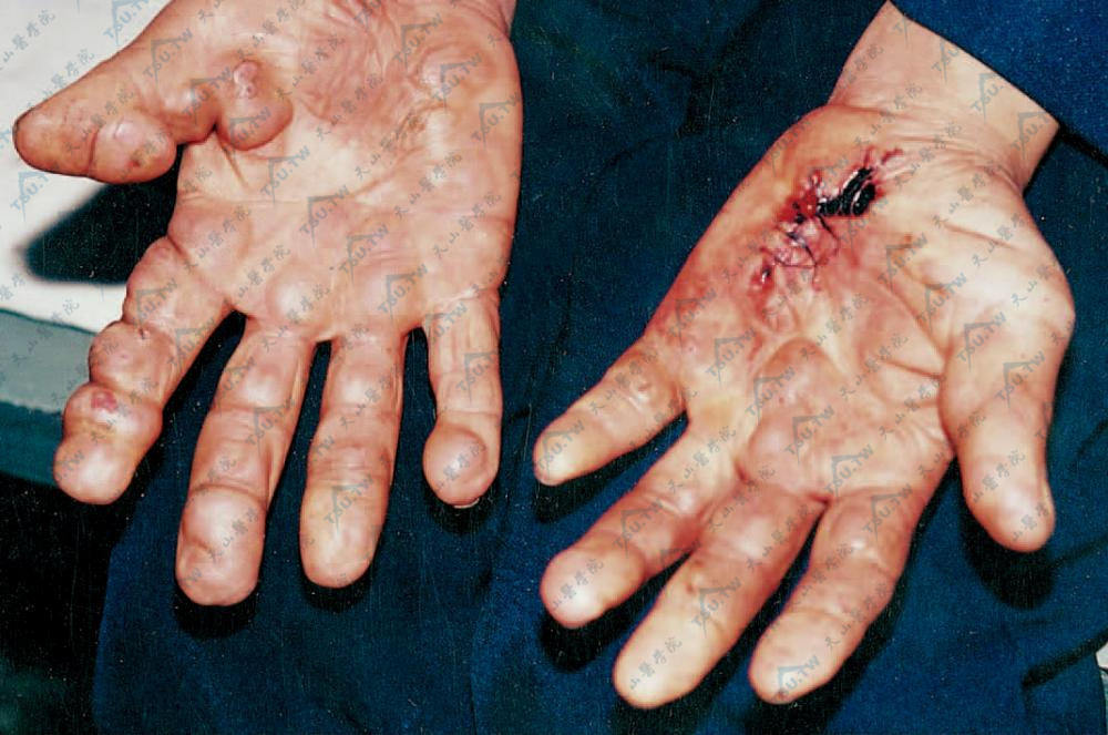 皮肤纤维瘤（Dermatofibroma）患者手部多发肉团，掌跖几十个呈扁球形、椭圆形、质地坚实的肤色结节
