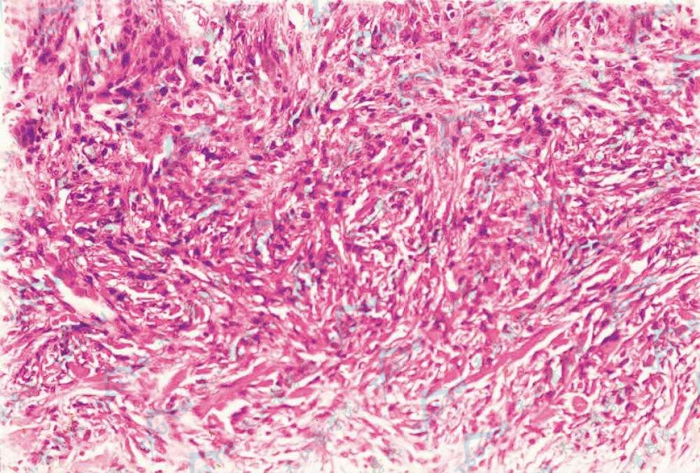 皮肤纤维瘤组织病理学改变：胶原纤维呈编织状，成纤维细胞核梭形，沿纤维平行排列