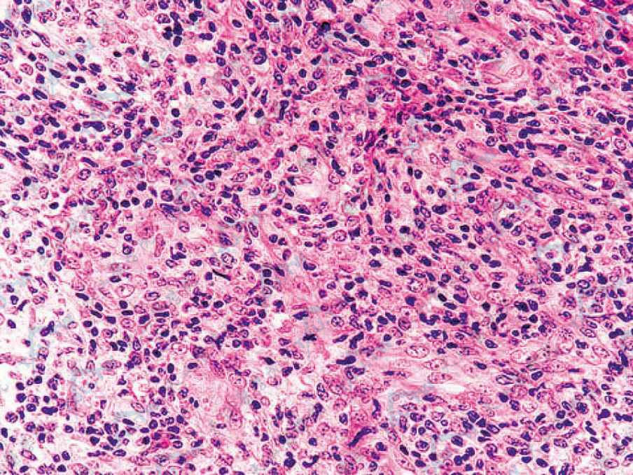 肿瘤主要由上皮样细胞组成，并伴有较多的浆细胞浸润，可见核分裂象