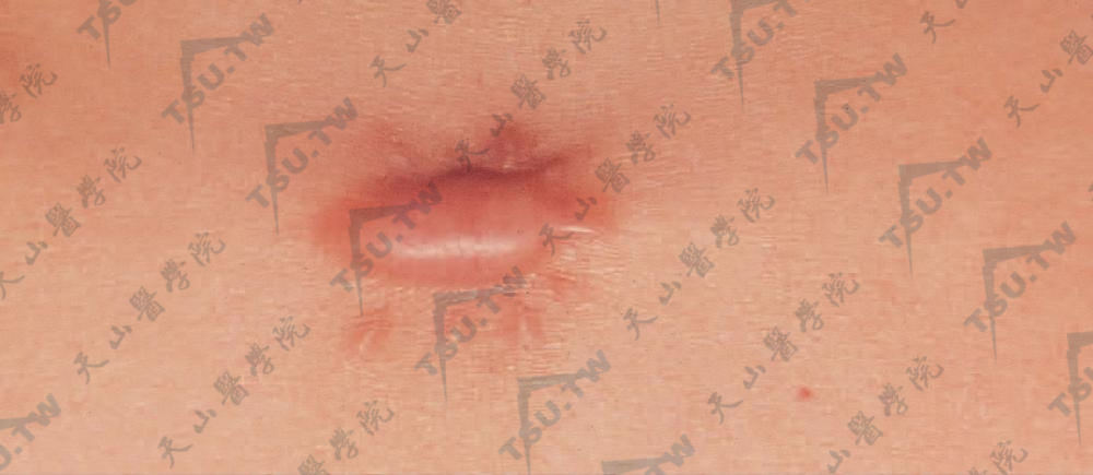 创伤愈合后，局部形成隆起性瘢痕，淡红色，境界清楚，表面可有毛细血管扩张
