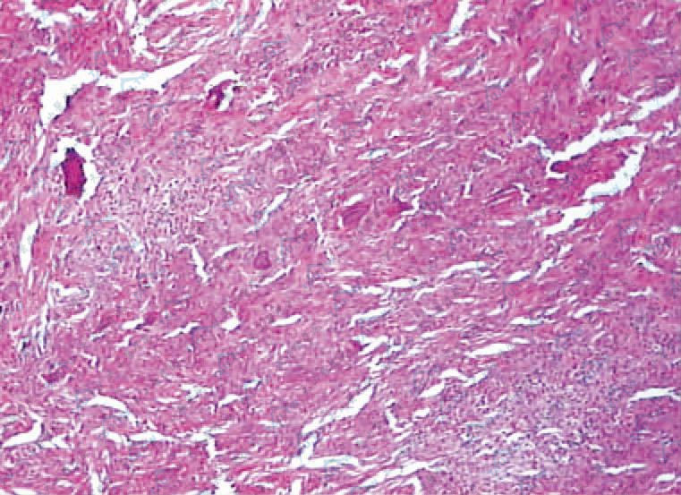 皮下瘤细胞团块，主要由组织细胞和巨细胞组成，团块周围有结缔组织纤维包绕、分隔