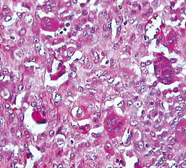 组织细胞核呈空泡状，巨细胞散在分布，胞核排列呈马蹄形或不规则分布