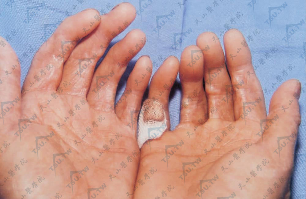 掌纤维瘤病患者手部症状