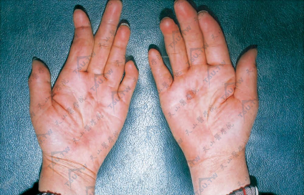 掌纤维瘤病患者手部症状