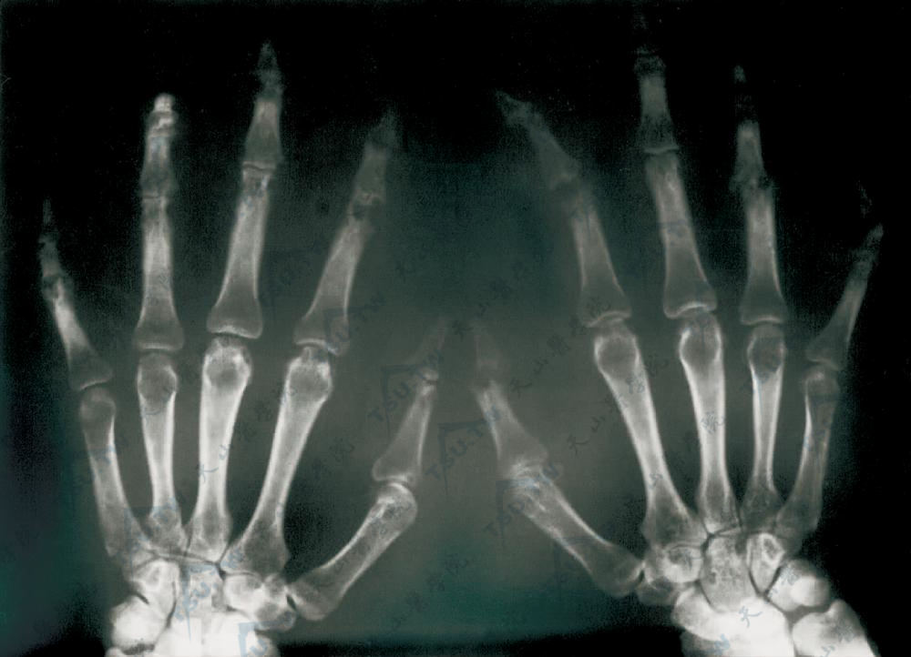 掌纤维瘤病：X线（双手正位片）双手手指见多发性骨缺损影，呈虫蚀状或圆形透光区，指骨间关节破坏