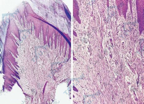肢端纤维角皮瘤组织病理学改变