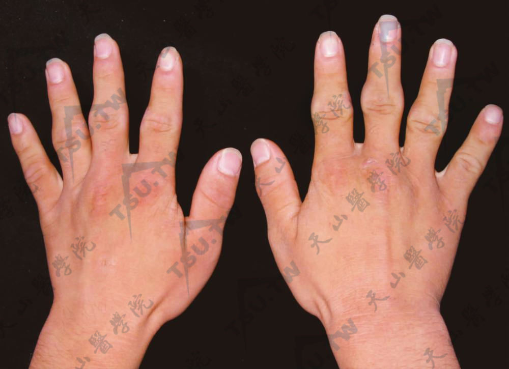 指厚皮症（Pachydermodactyly）症状：手指关节增粗
