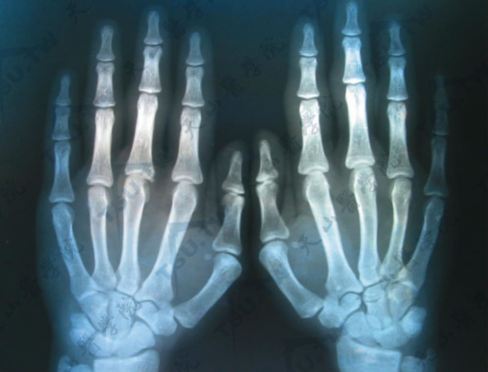 指厚皮症（Pachydermodactyly）患者手指膨胀增粗部位骨与关节正常