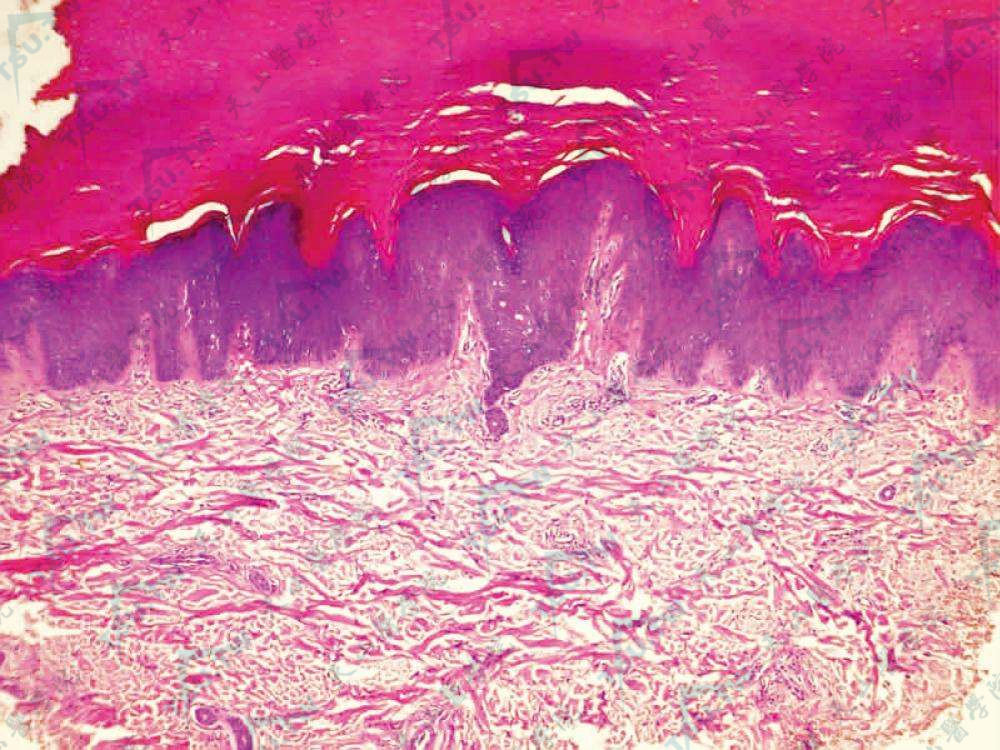 指厚皮症组织病理学改变：表皮明显角化过度，棘层肥厚