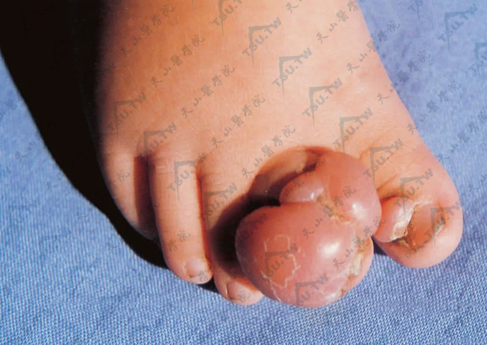 婴儿指（趾）纤维瘤病