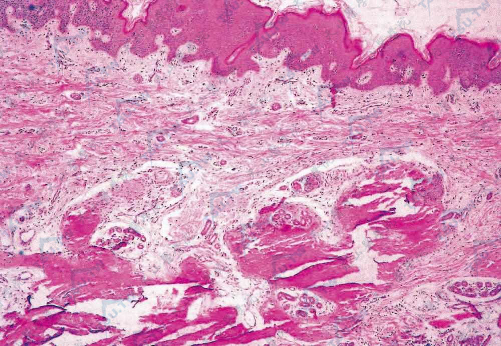 肿中瘤组织位于真皮内，与周围结缔组织分界清楚，由瘤细胞和基质构成