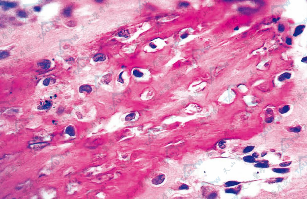 月中瘤基质PAS染色阳性（PAS染色×400）