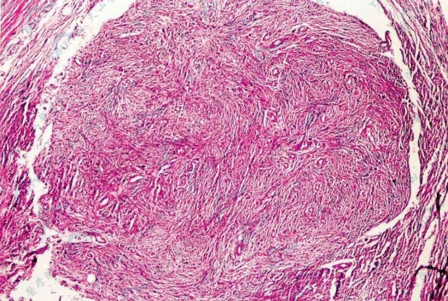 结节性筋膜炎组织病理学改变：真皮及皮下组织有大量梭形细胞增生