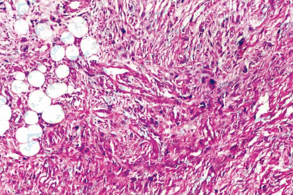 结节性筋膜炎组织病理学改变：真皮及皮下组织有大量梭形细胞增生，其间可见核异形的成纤维细胞，席纹状分布的纤维细胞