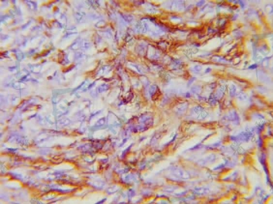 血管瘤样纤维组织细胞瘤组织病理学改变：免疫组化染色示肿瘤细胞SMA阳性