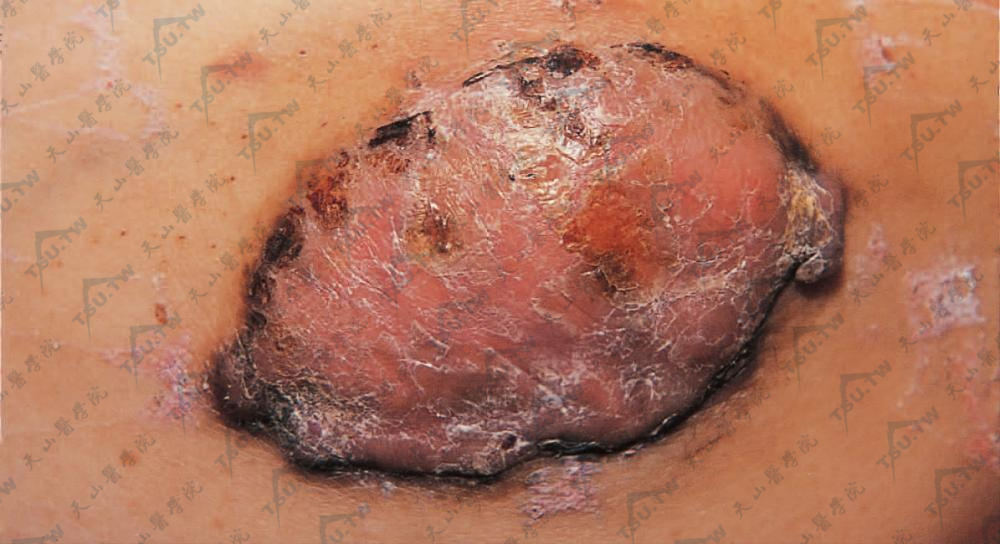 隆突性皮肤纤维肉瘤（Dermatofibrosarcoma Protuberans，DFSP）症状