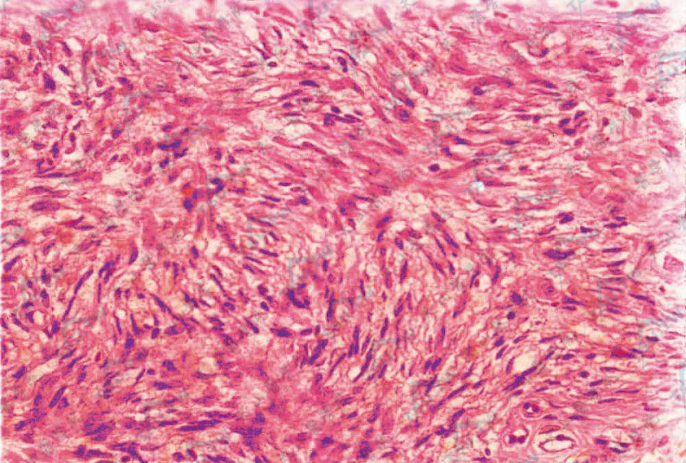 隆突性皮肤纤维肉瘤（Dermatofibrosarcoma Protuberans，DFSP）组织病理学改变：瘤细胞梭形，形态稍不一致，交织成旋涡状（HE染色×400）
