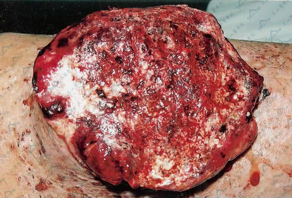恶性纤维组织细胞瘤患者症状：右胫前一肿块，表面皮肤破溃、出血