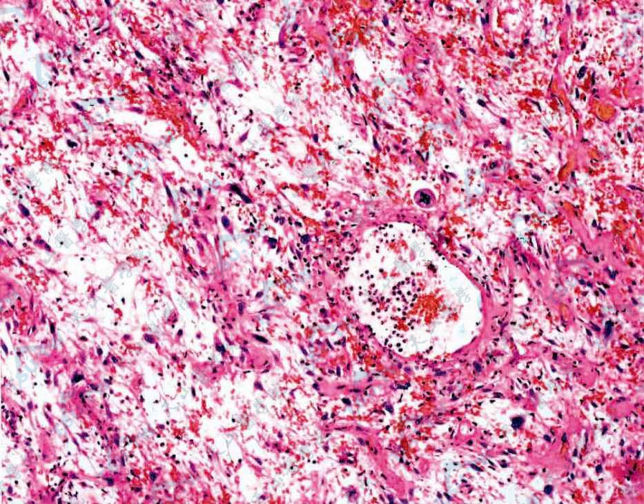 恶性纤维组织细胞瘤：组织病理学改变