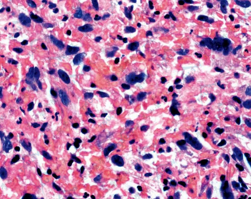 恶性纤维组织细胞瘤肿瘤细胞排列呈梭形或星形，可见多核瘤巨细胞（HE染色×400）