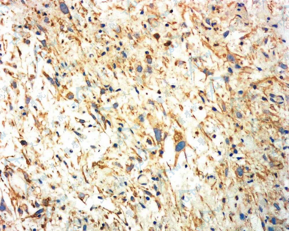 恶性纤维组织细胞瘤肿瘤细胞胞质vimentin（＋）（EnVision二步法染色×200）