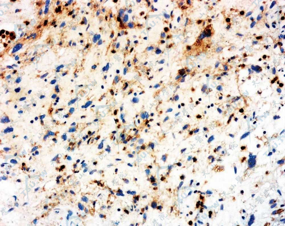 恶性纤维组织细胞瘤肿瘤细胞胞质CD68＋（EnVision二步法染色×200）