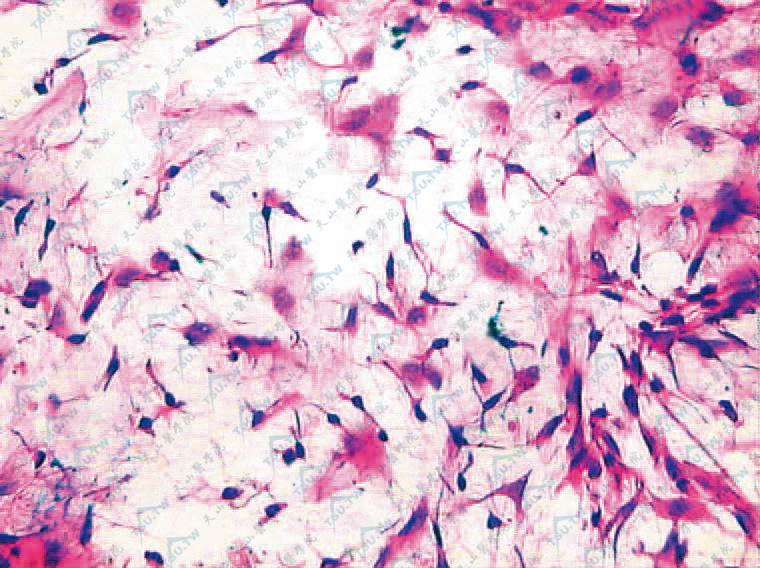 整个肿瘤内充满黏液样基质，其间散在星形及纺锤形细胞
