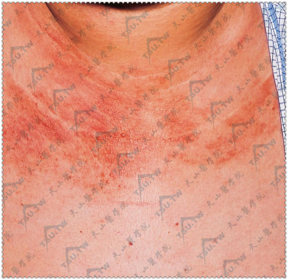 多中心网状组织细胞增生症症状：上胸部弥漫分布红斑及粟粒状红色丘疹