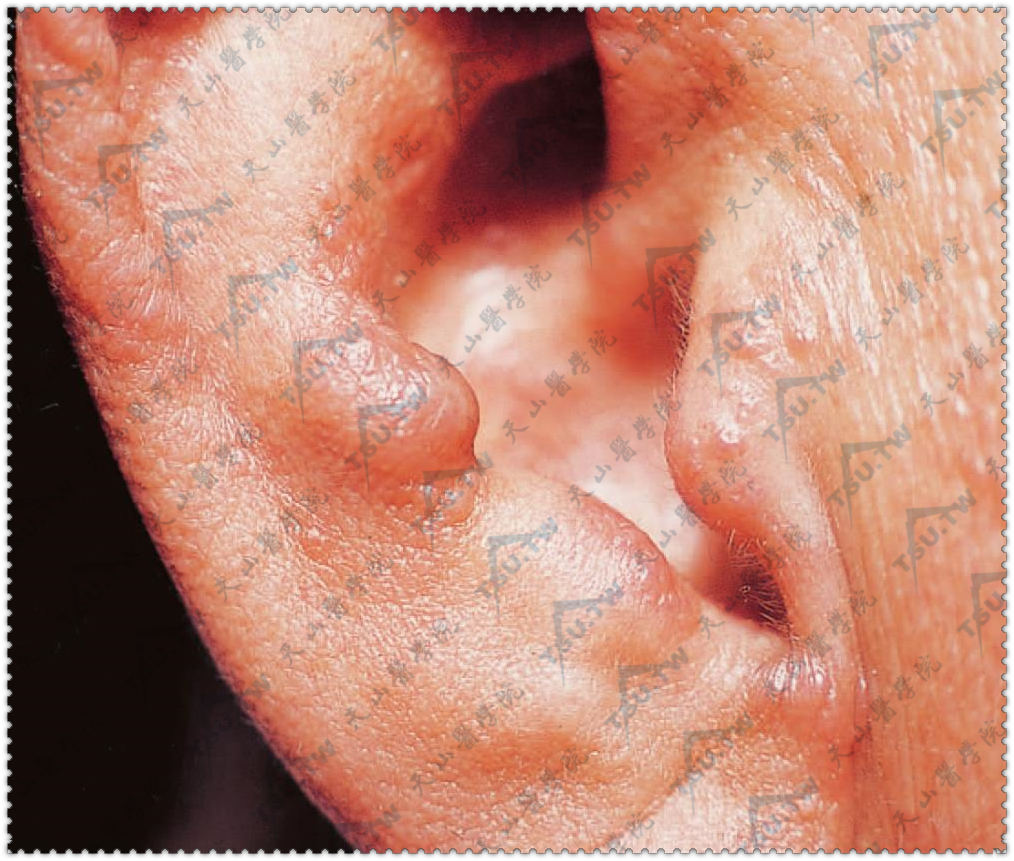 多中心网状组织细胞增生症症状：耳廓见多数粟粒大至绿豆大，淡棕红色、皮肤色丘疹及结节，半球形，顶端略平，有的中央凹陷