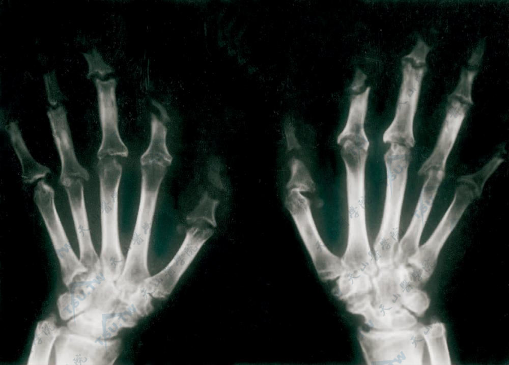 多中心网状组织细胞增生症症状：双手指掌指骨近端骨质破坏，缺损